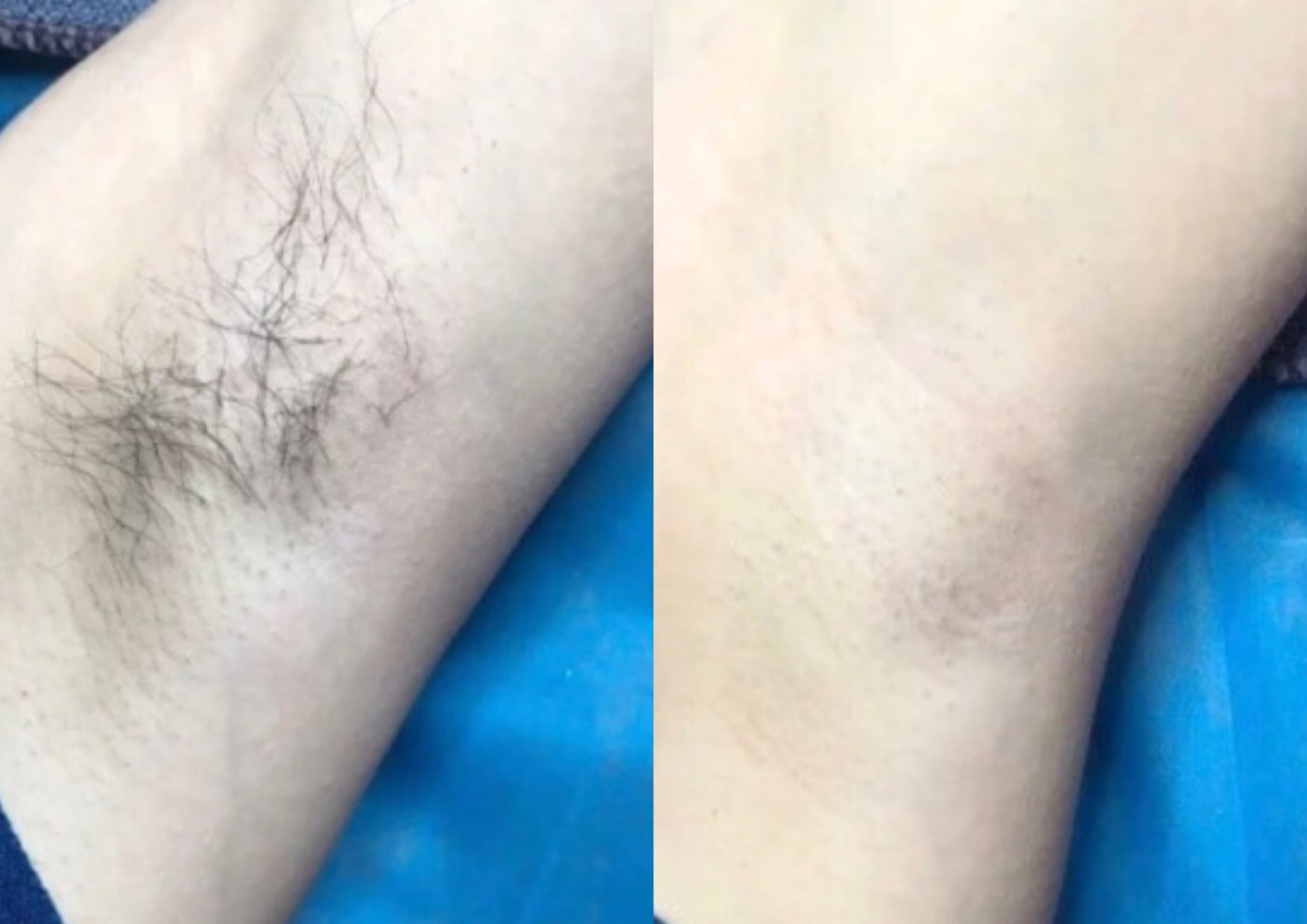 diaminy painless hair removal machine before and after