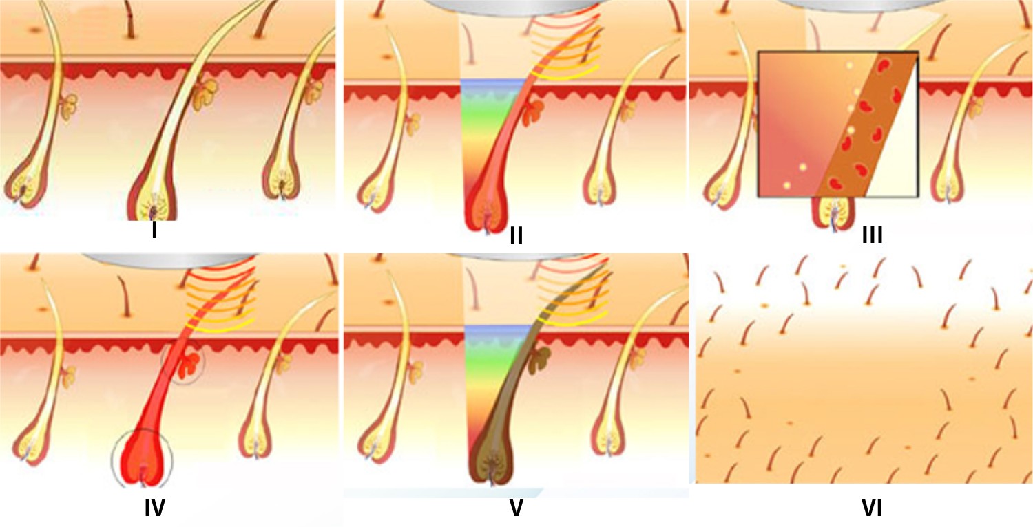 diaminy working principle of ipl hair removal