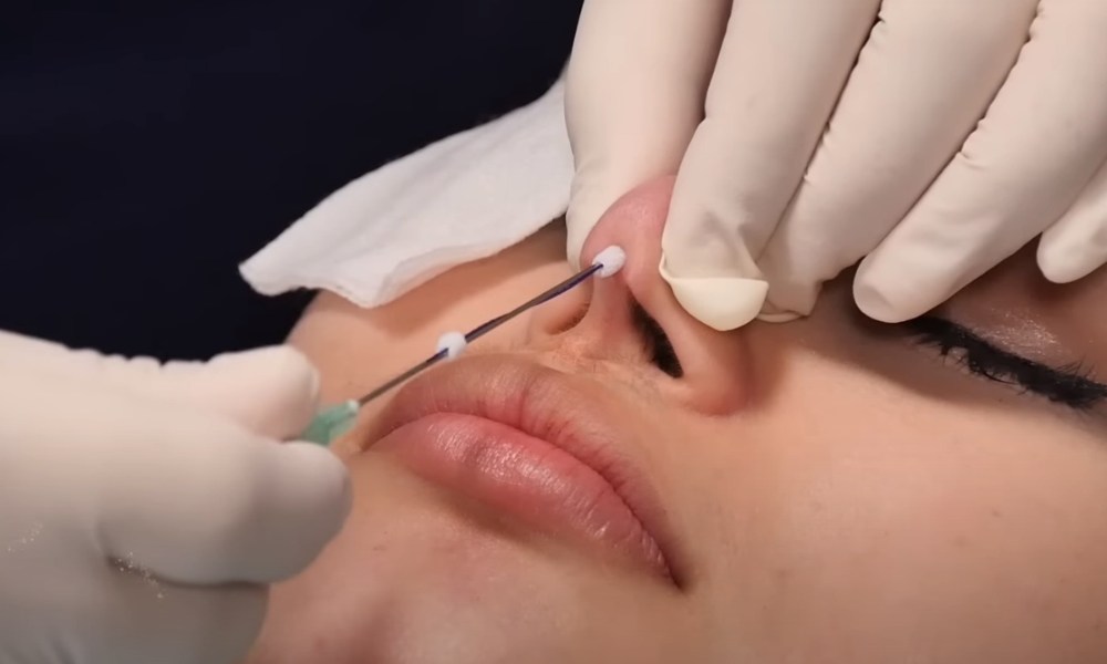 nose thread lift