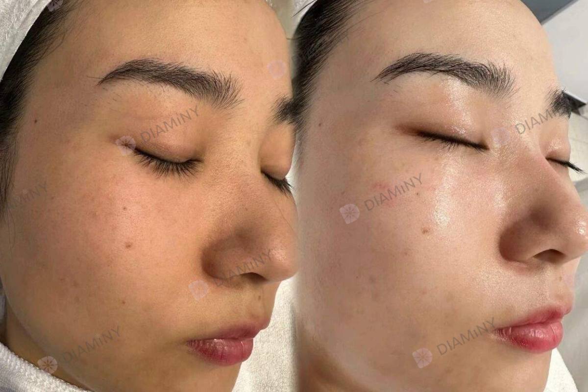 HA essence benefits