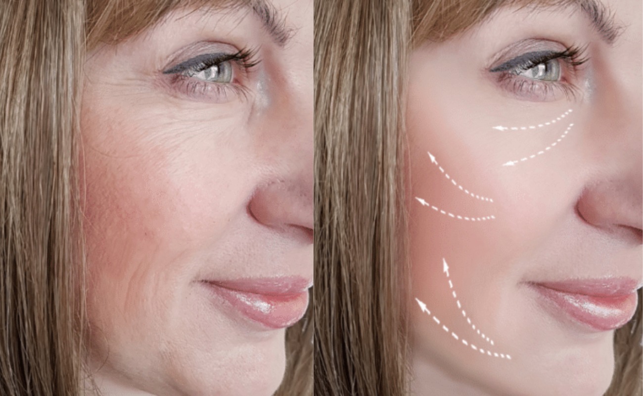 Radiofrequency Facial Before & After