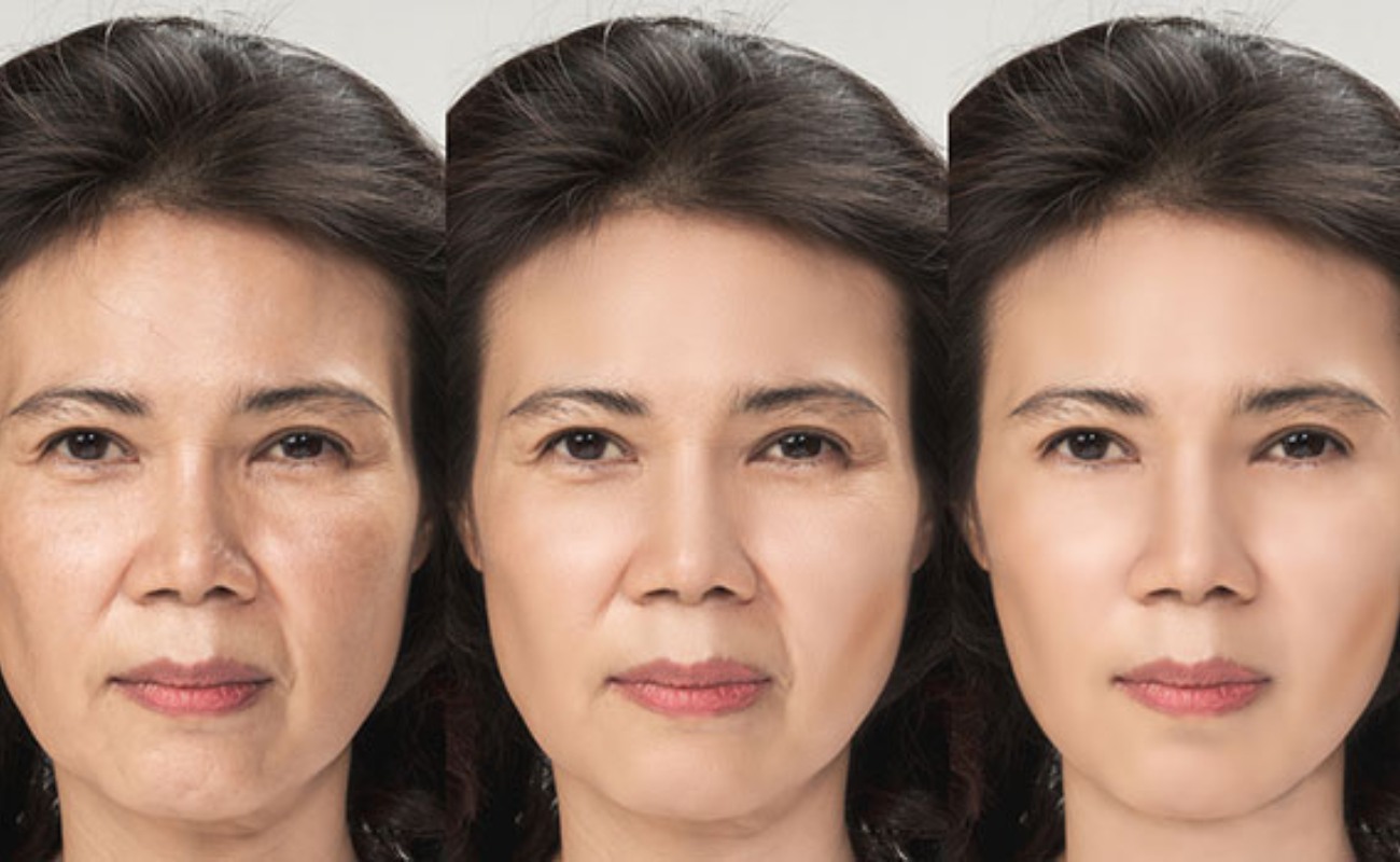 Radiofrequency Facial Before & After