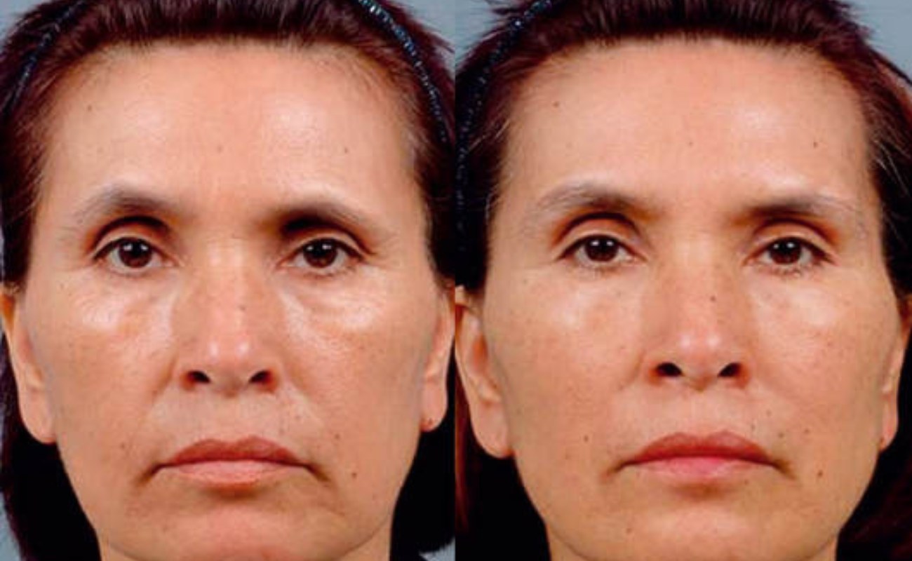 Radiofrequency Facial Before & After