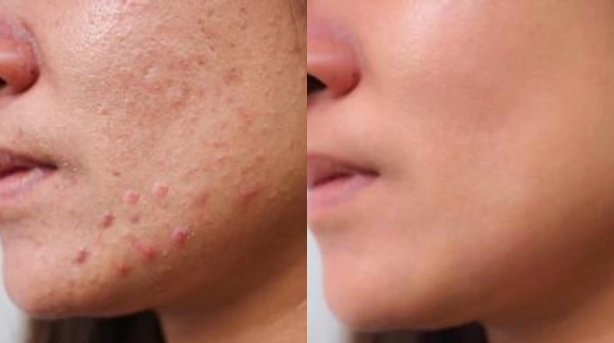 Comparison Before and After Using Ultrasonic Skin Scrubber