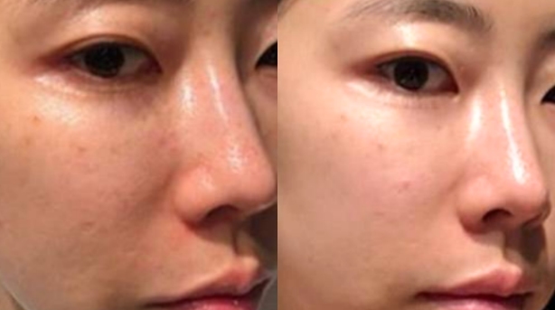 Comparison Before and After Using Ultrasonic Skin Scrubber
