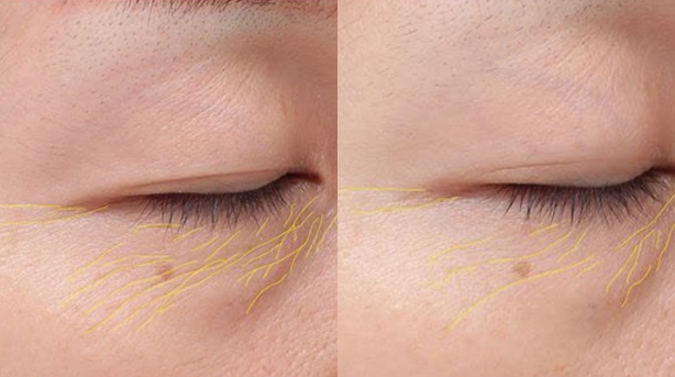 Comparison Before and After Using Ultrasonic Skin Scrubber