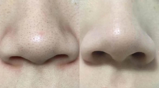 Comparison Before and After Using Ultrasonic Skin Scrubber