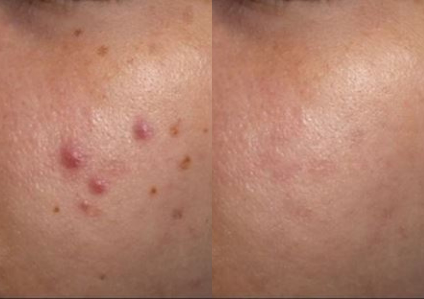 diaminy led face mask before and after