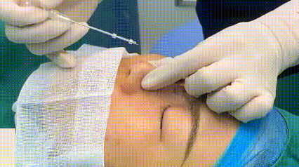 PCL nose thread lift procedure