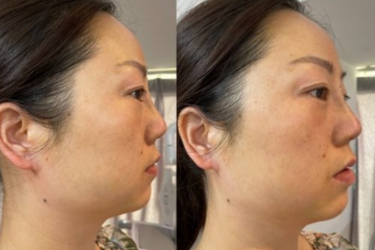 nose thread lift before and after