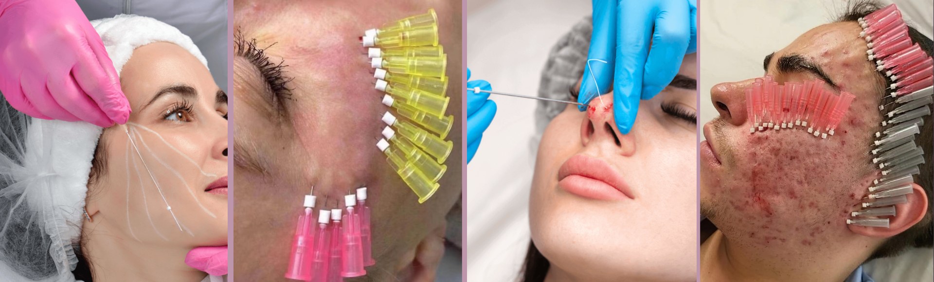 Benefits of Diaminy PCL threads