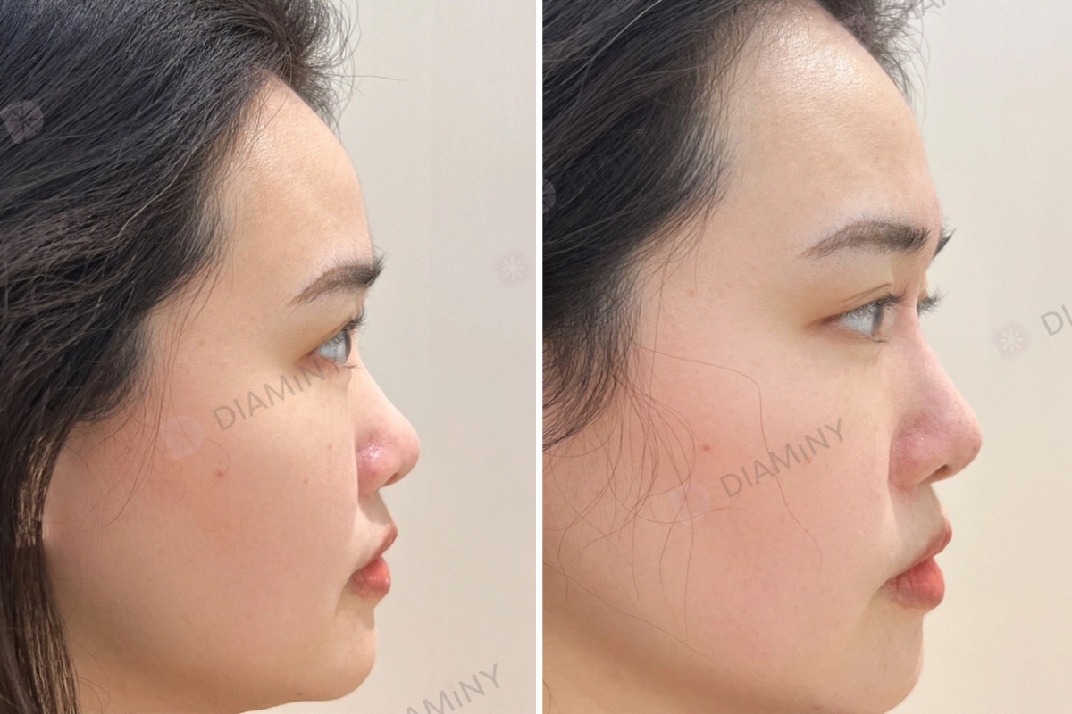 nose thread lift before and after