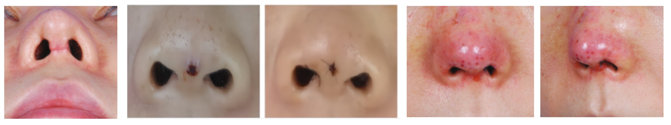 nose thread lift before and after