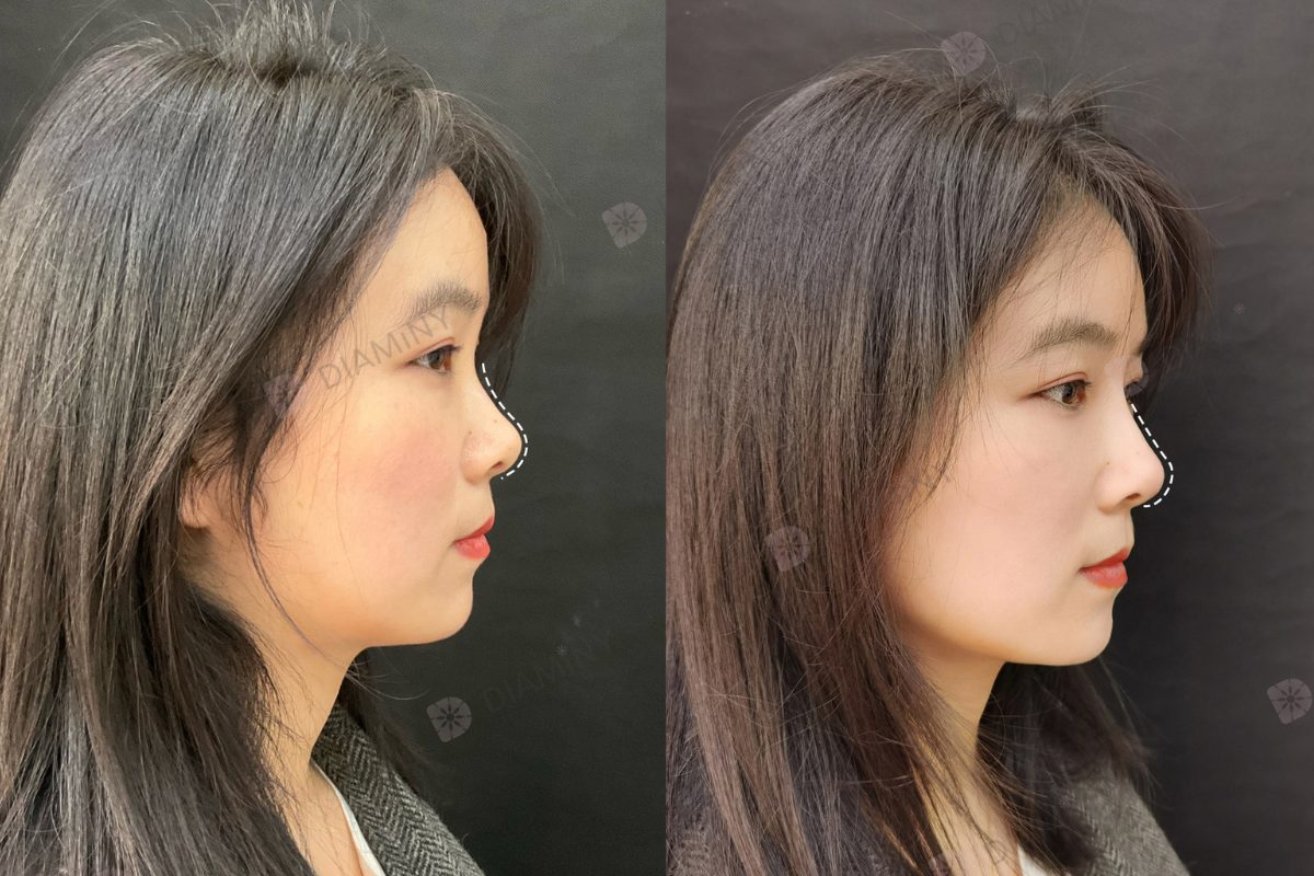 nose thread lift before and after