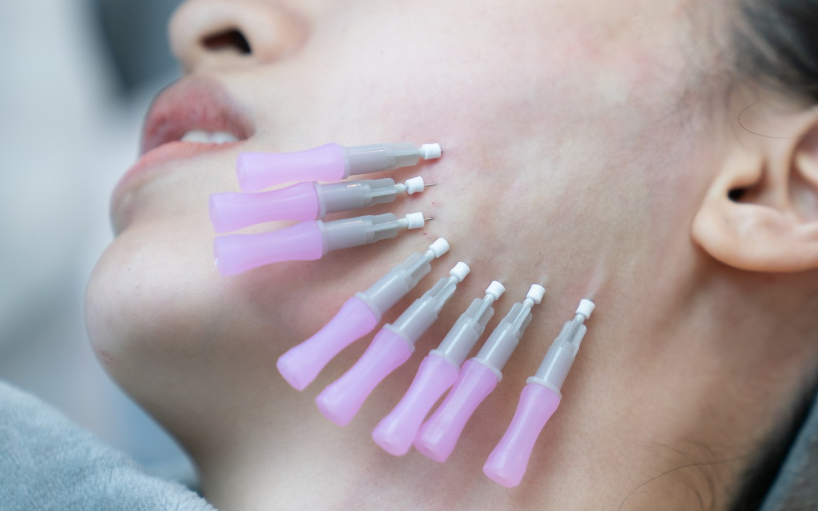 thread lift 