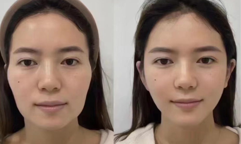 three months after thread lift
