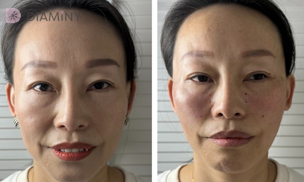 instant result of facial thread lift