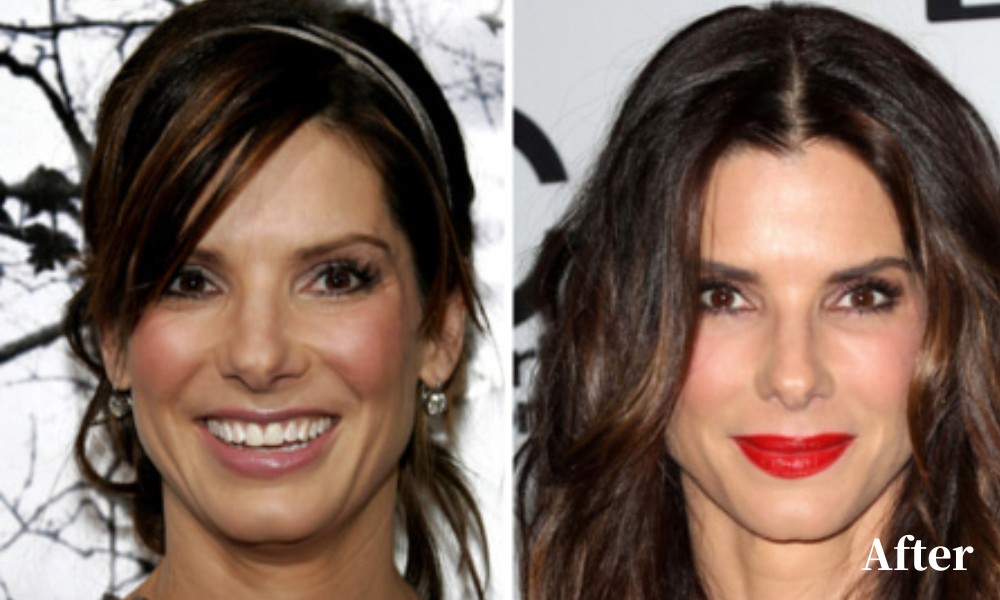 Celebrities Who Did a PDO Thread Lift