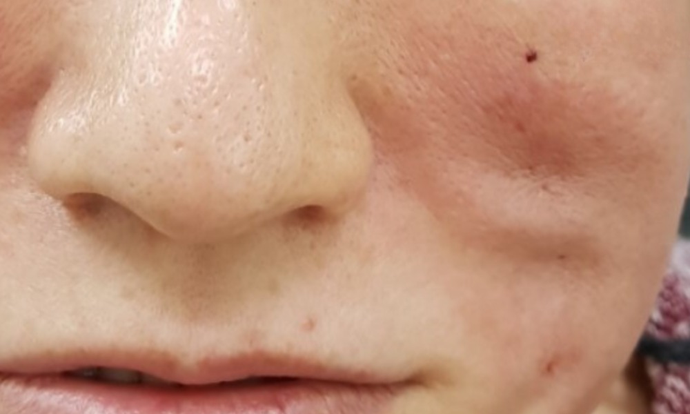 lumps after thread lift