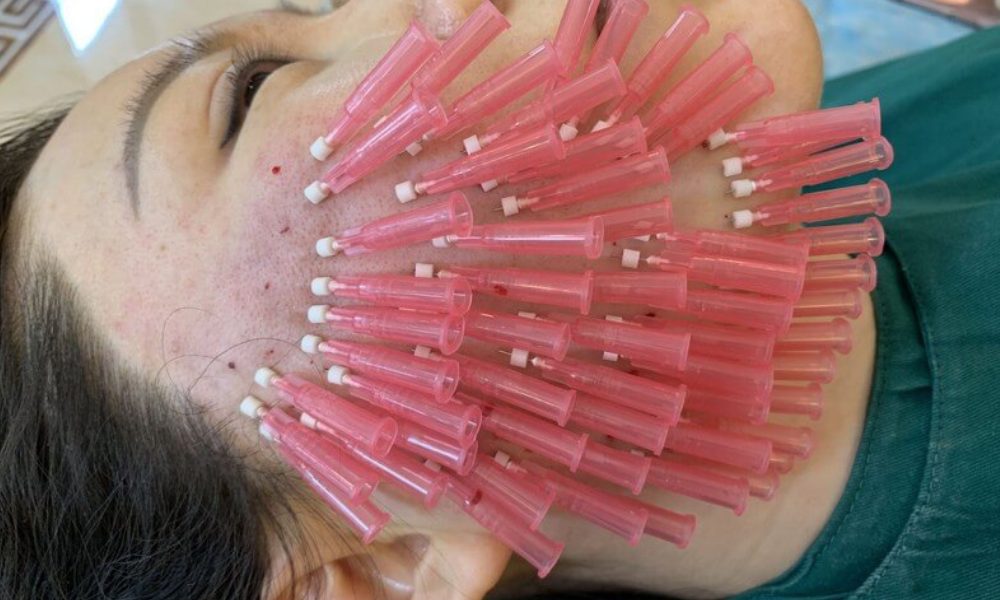 thread lift