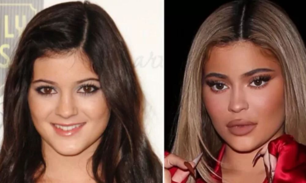 Celebrities Who Did a PDO Thread Lift