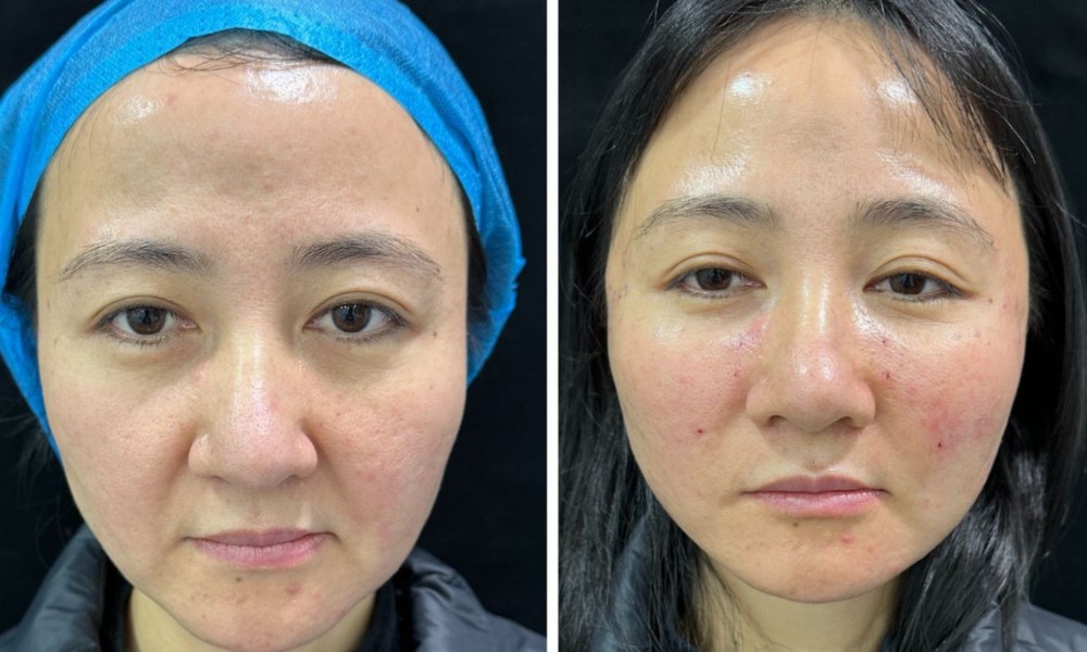 thread lift before and after