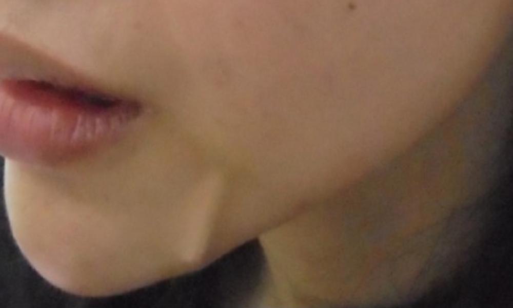 three months after thread lift