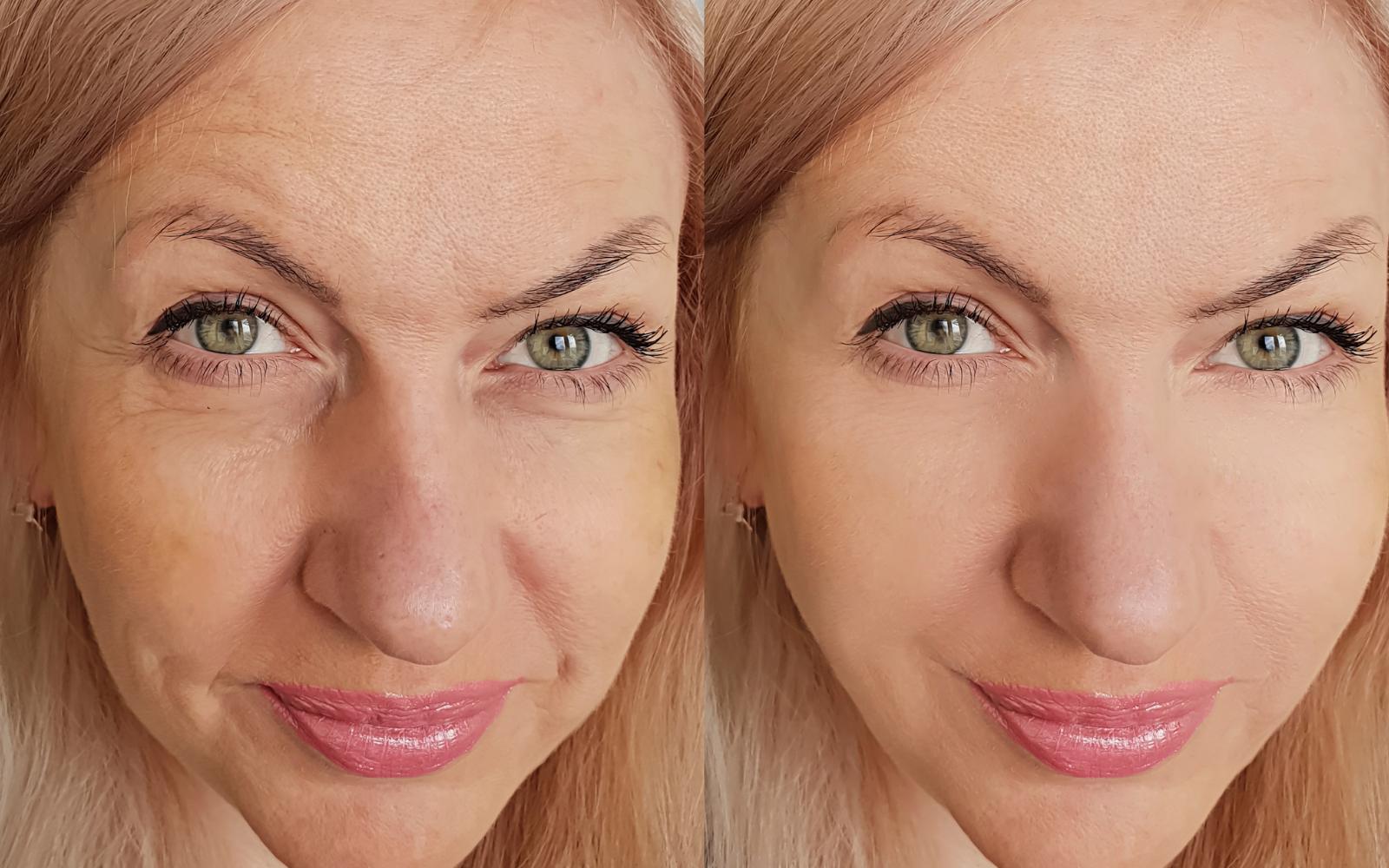 three months after thread lift