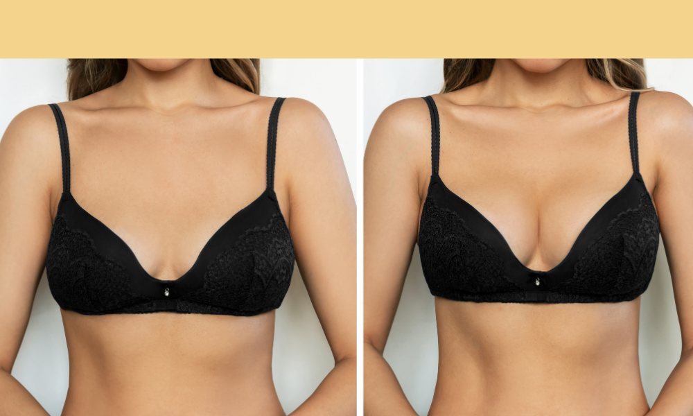 breast augmentation with PDO threads