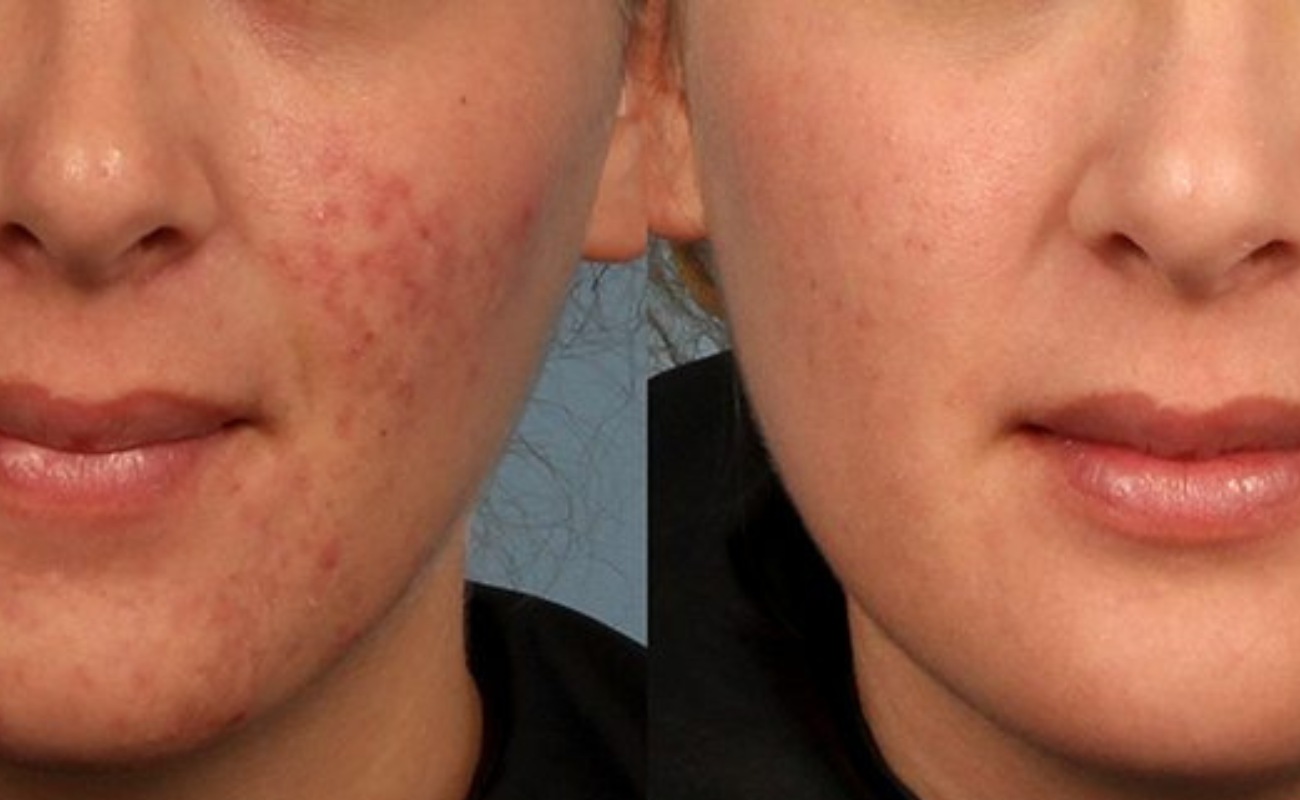 Derma Roller for Acne Scars