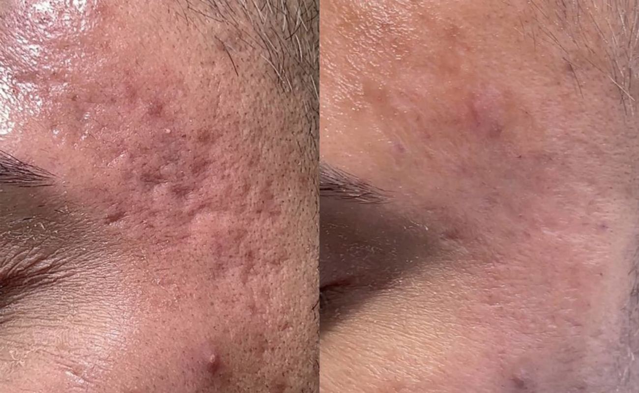 Derma Roller for Acne Scars