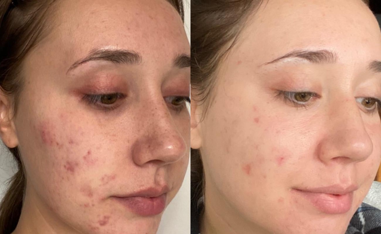 Derma Roller for Acne Scars