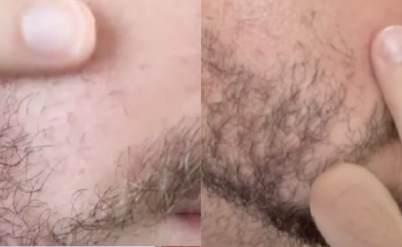 Derma Roller for Beard