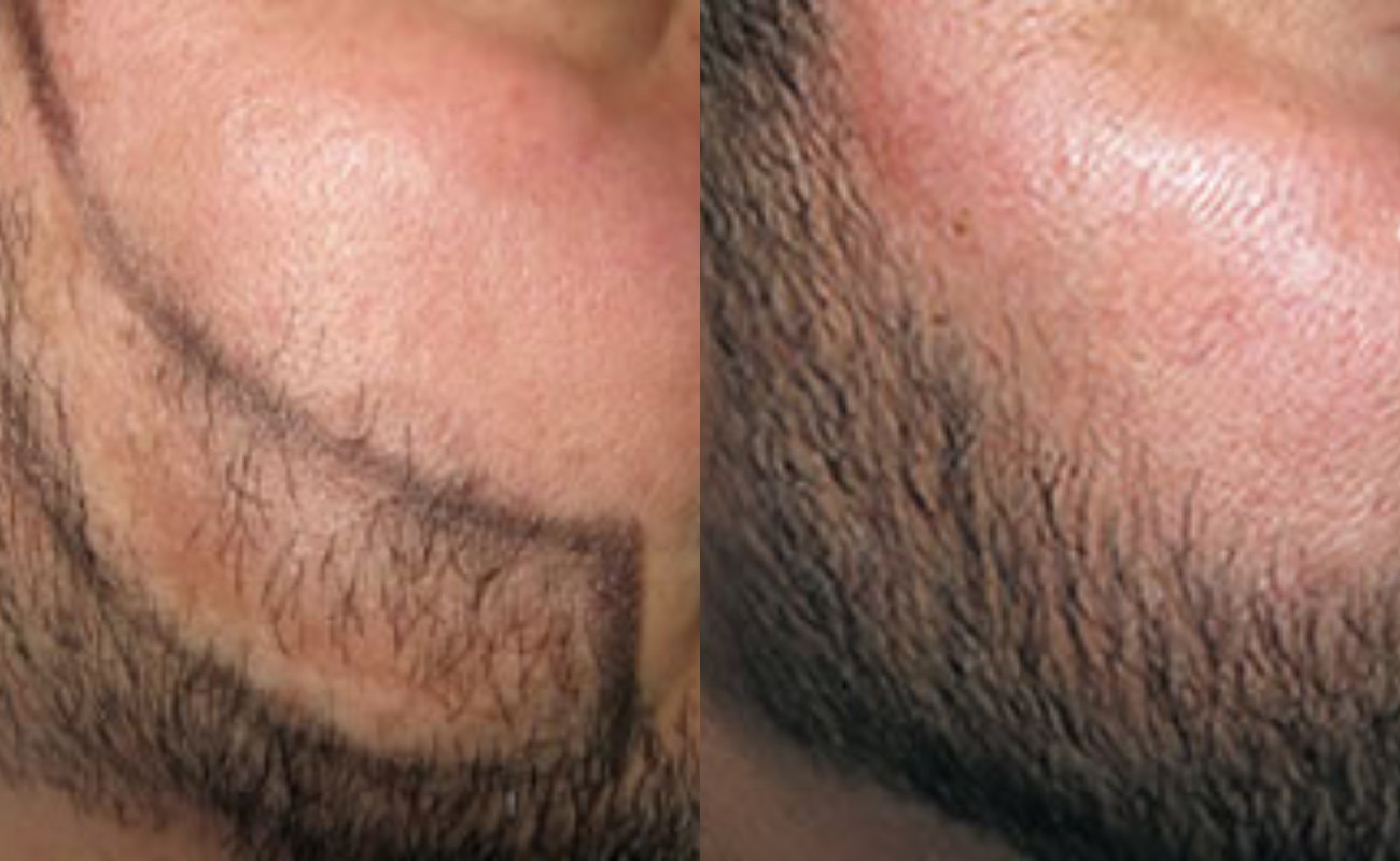 Derma Roller for Beard