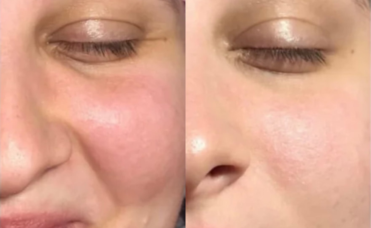 Derma Roller for Face