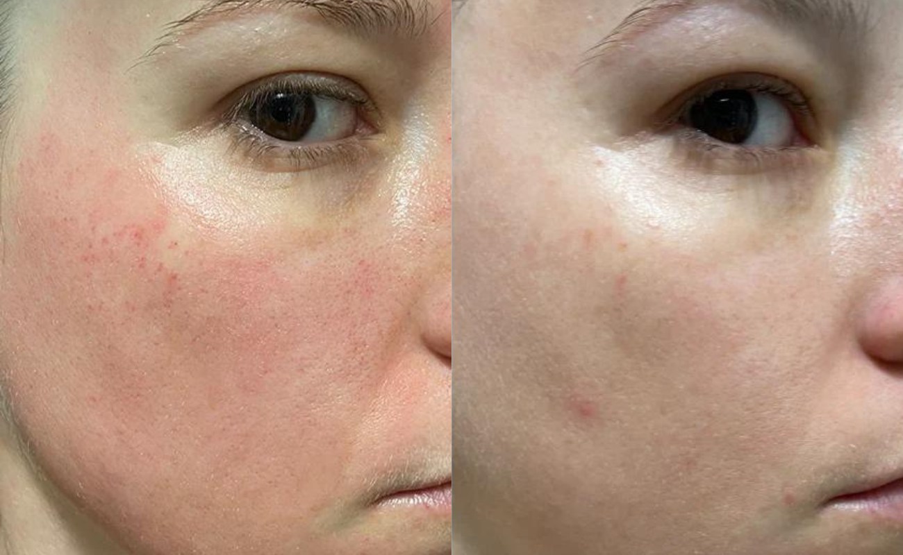 Derma Roller for Face