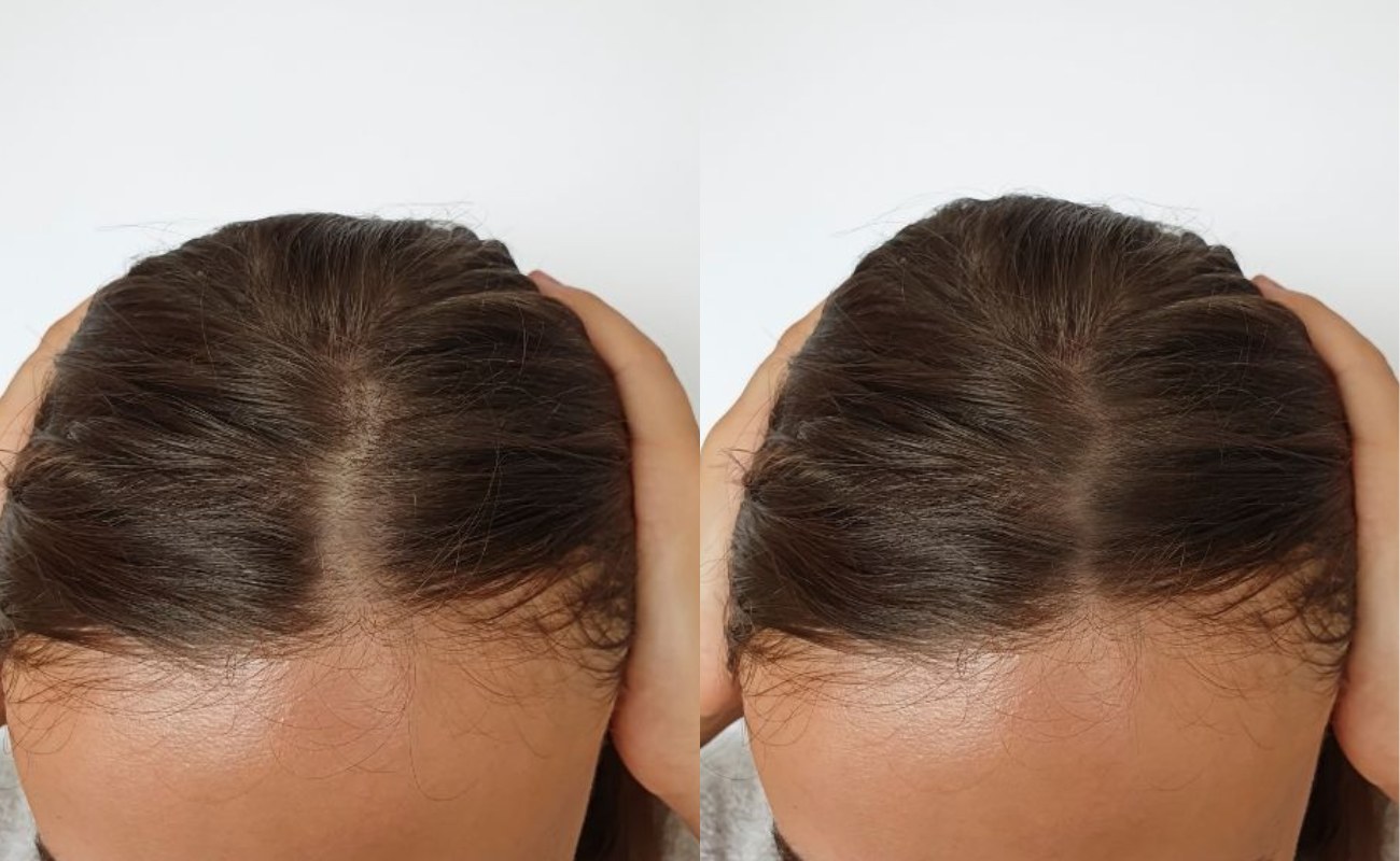 Derma Roller for Hair Growth