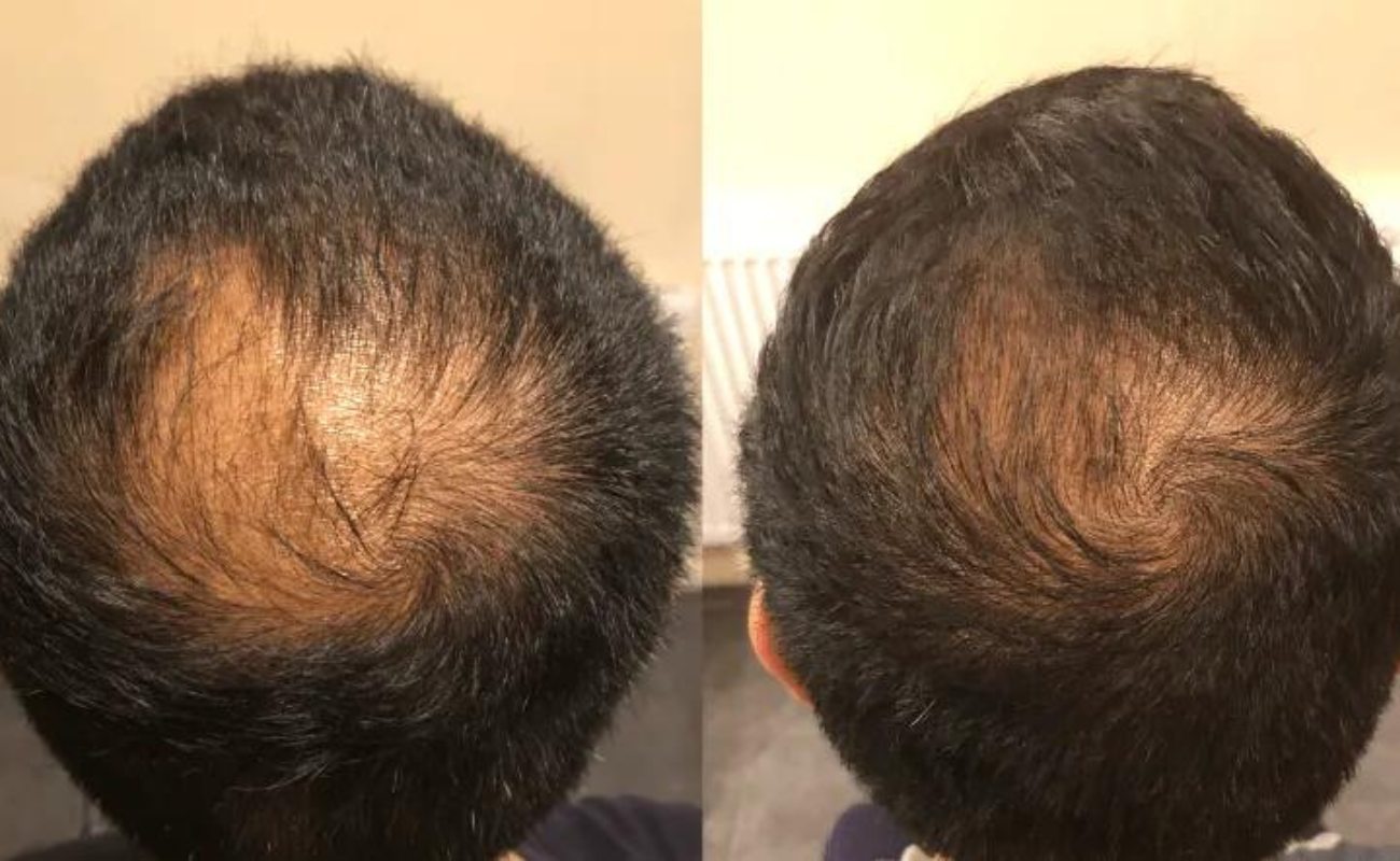 Derma Roller for Hair Growth