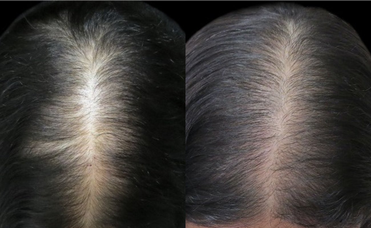 Derma Roller for Hair Growth