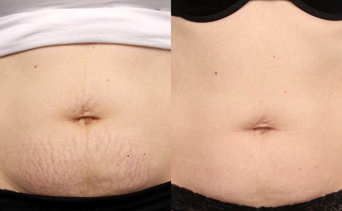 Derma Roller for Stretch Marks