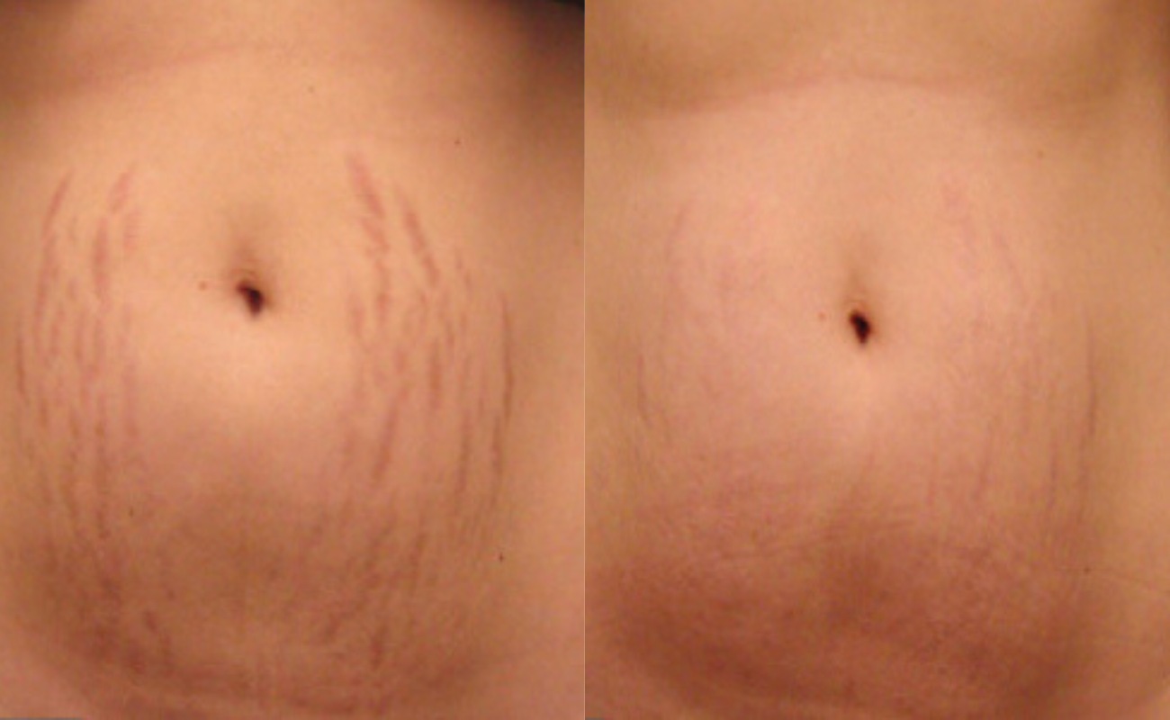Derma Roller for Stretch Marks