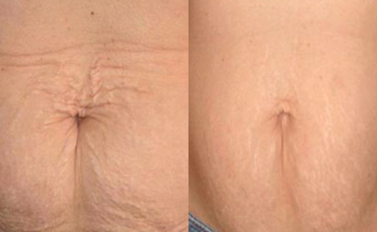 Derma Roller for Stretch Marks