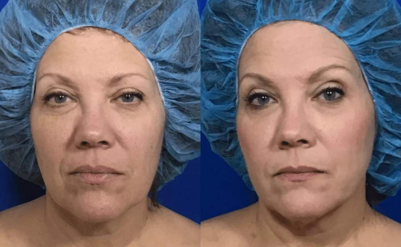 Face Lift Before& After
