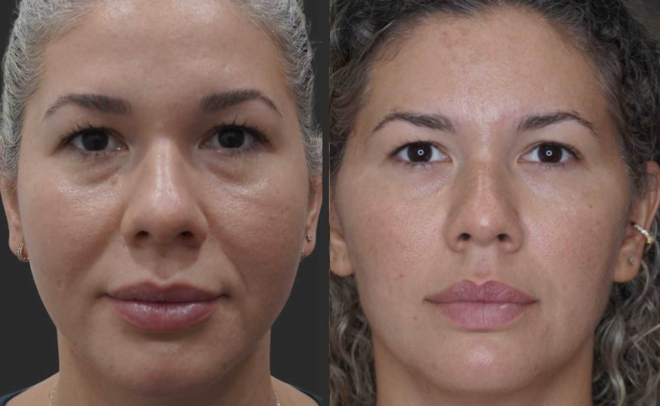 Face Lift Before& After