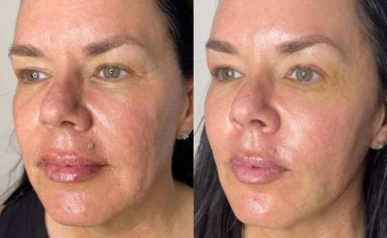 Face Lift Before& After
