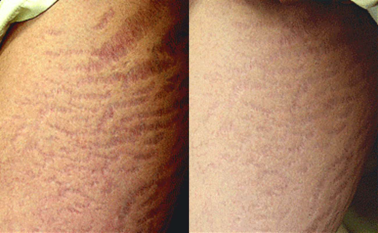 For Stretch Marks