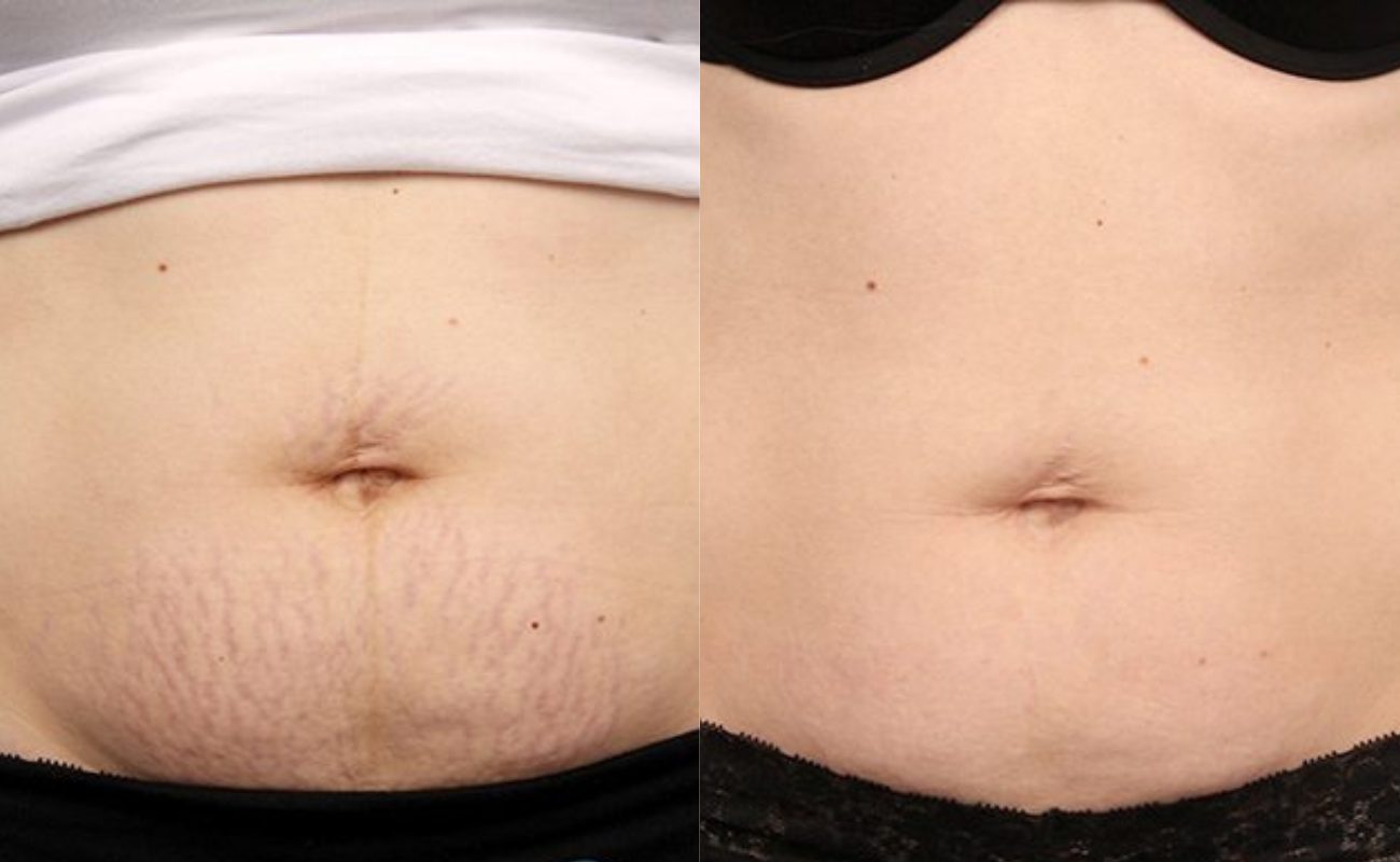 For Stretch Marks