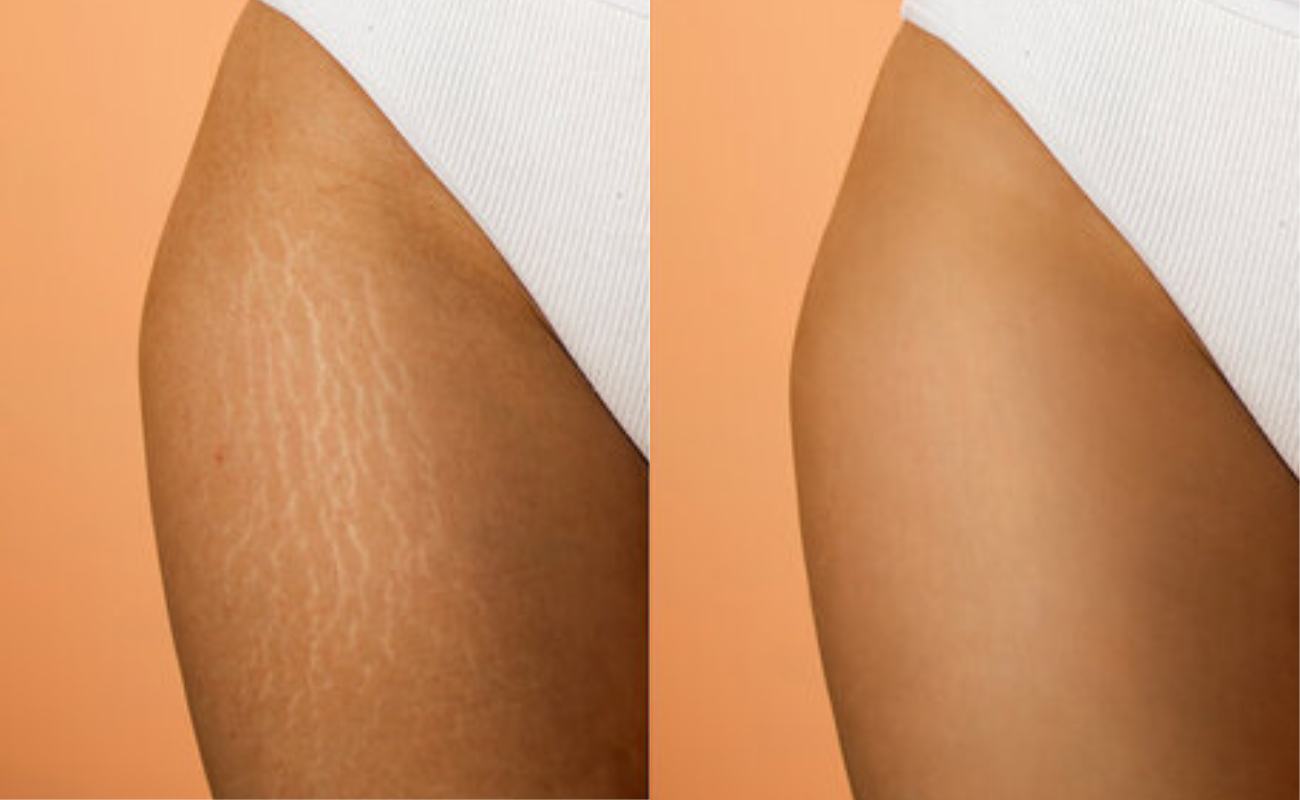 For Stretch Marks