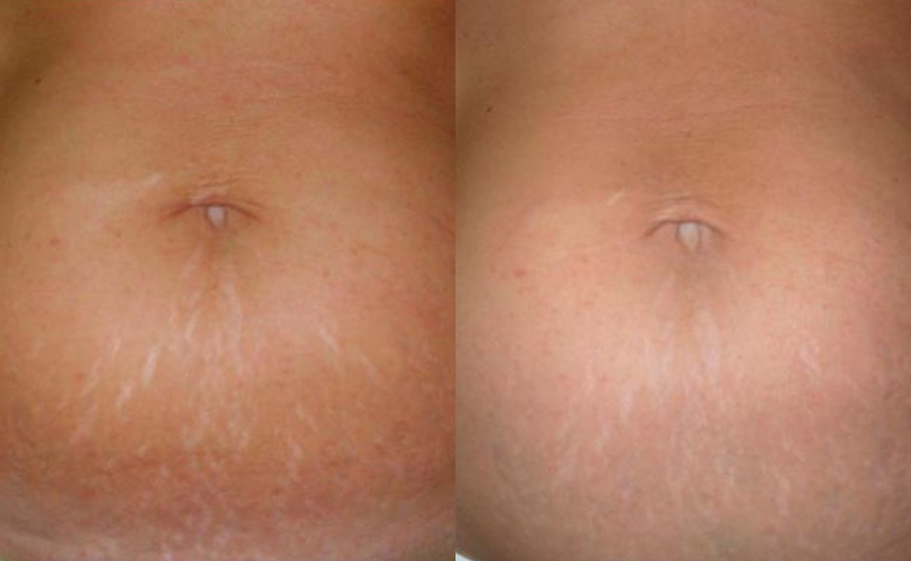 For Stretch Marks