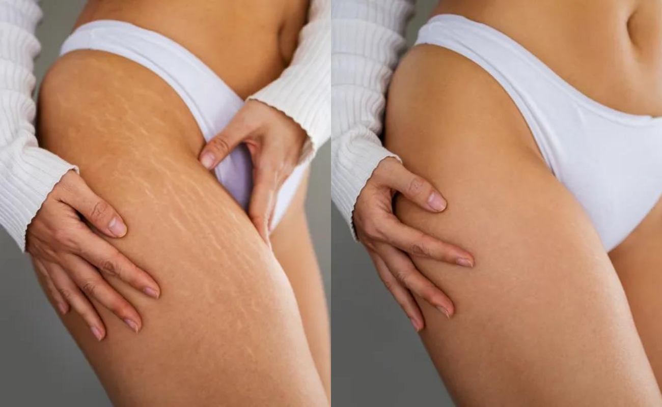 For Stretch Marks